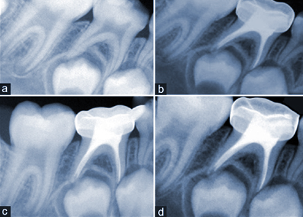 pulpectomy pulpotomy